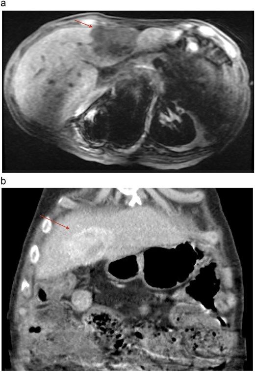 Imaging revealing a heterogeneous, hypervascular lesion in the left hepatic lobe.