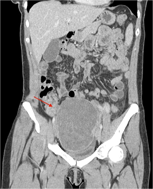 Figures depicting the image of a uterine PEComa and its associated pathological features.