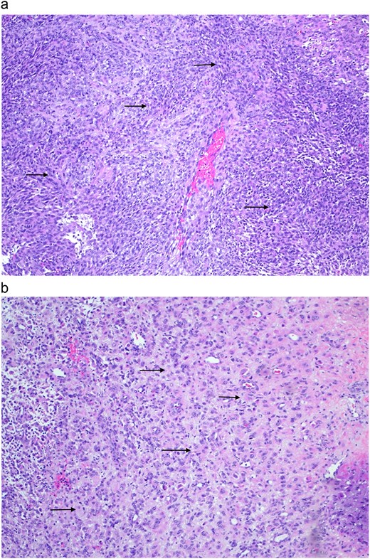 Figures depicting the image of a uterine PEComa and its associated pathological features.