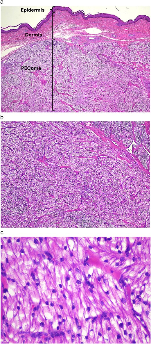 Figures showing the distinctive cell type and arrangement of a soft tissue PEComa.