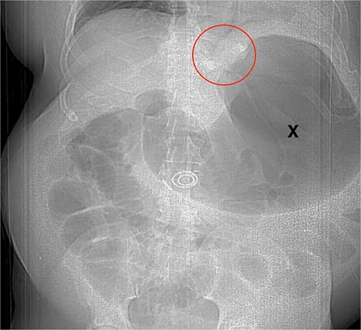 An x-ray showing distended loops of bowel and stomach.