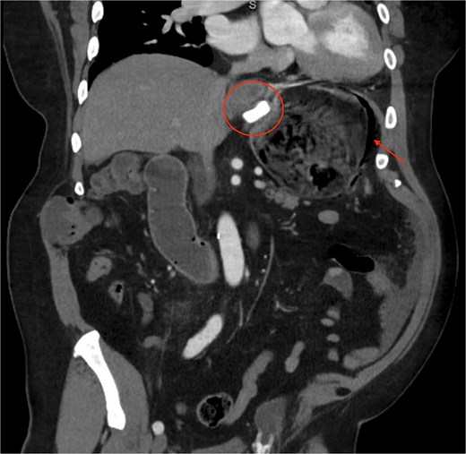 A representative slice of a CT scan showing the gastric band placement, the distended stomach, and the signs of ischemia and perforation.
