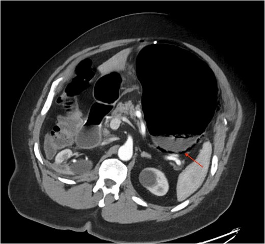 A representative slice of a CT scan showing more areas of the distended stomach and signs of ischemia and perforation.