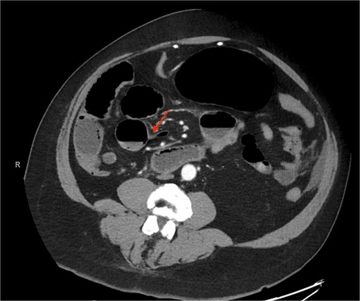 A representative slice of a CT scan showing the distal point of obstruction due to the adhesions from the prior nephrectomy surgery.
