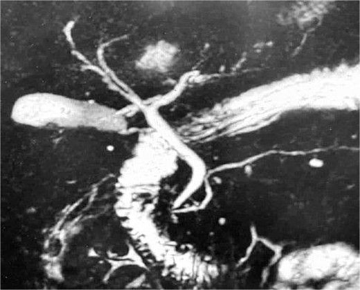 MRCP showing normal-caliber cystic and common bile ducts without biliary dilatation or evidence of choledocholithiasis, indicating no persistent biliary obstruction.