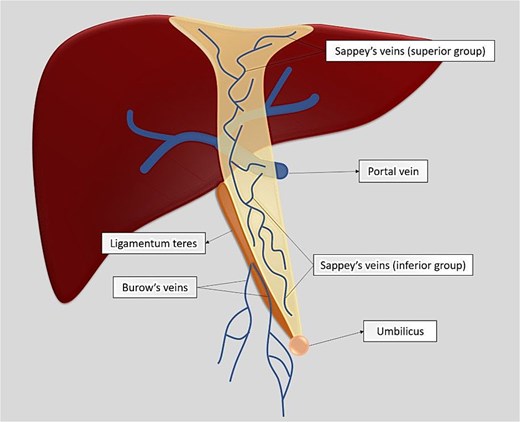 Schematic diagram illustrating the paraumbilical venous network surrounding the ligamentum teres hepatis, demonstrating a potential route for ascending spread of infection from the umbilicus to the hepatic round ligament via paraumbilical veins.
