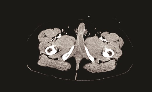Axial contrast-enhanced CT image of the pelvis demonstrating asymmetrical enlargement of the left corpus cavernosum with an internal hypodense area and peripheral enhancement, consistent with partial segmental thrombosis.
