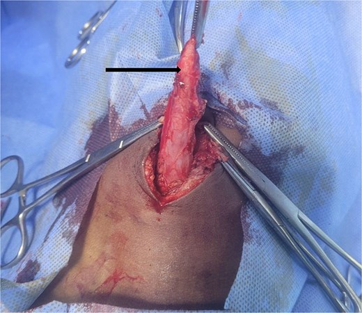Intraoperative photograph showing a dissected tubular urachal diverticulum grasped by surgical forceps at its umbilical attachment.