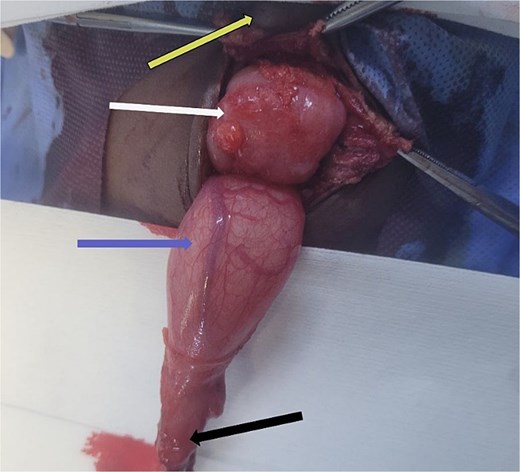 Intraoperative photograph with arrows identifying the urachal diverticulum, bladder, sigmoid colon, and umbilicus.