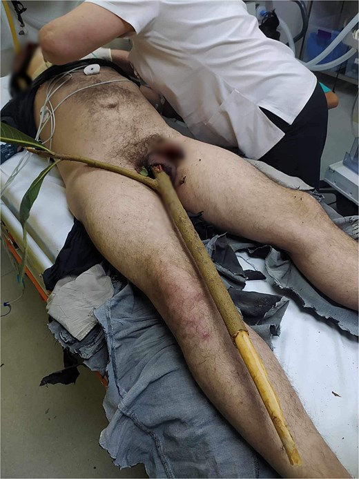 An anonymized photograph showing a sharpened wooden foreign body protruding from the right hemiscrotal entry site during the initial presentation after penetrating trauma.