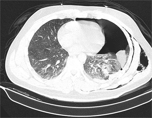 Contrast-enhanced axial chest CT image showing a left-sided hemopneumothorax with associated pulmonary contusion and areas of subcutaneous emphysema.