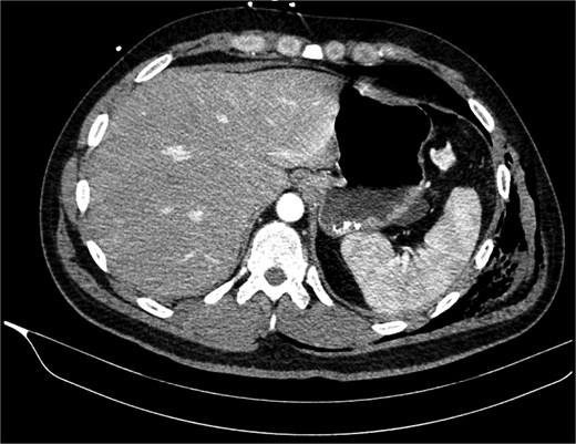Contrast-enhanced axial abdominal CT image showing hemoperitoneum and visceral injury along the suspected path of the penetrating wooden foreign body.