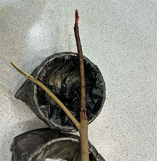 Wooden foreign body fragments retrieved from the abdominal cavity during laparotomy.