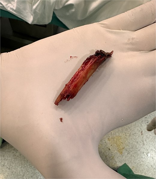 Wooden foreign body fragment retrieved from the pulmonary parenchyma during thoracoscopic intervention.