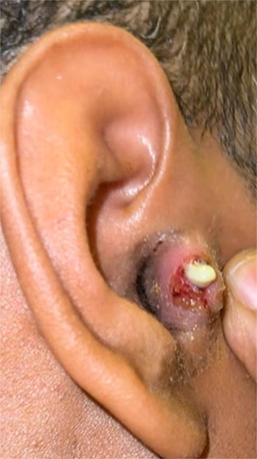 Photograph of the right external ear showing localized tragal swelling with spontaneous purulent drainage.