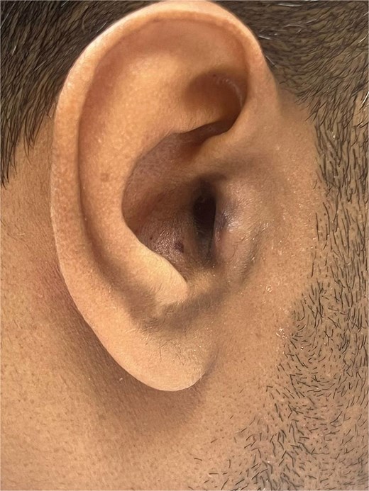 Follow-up photograph of the right external ear showing improved tragal appearance with mild hyperpigmentation and no active discharge.