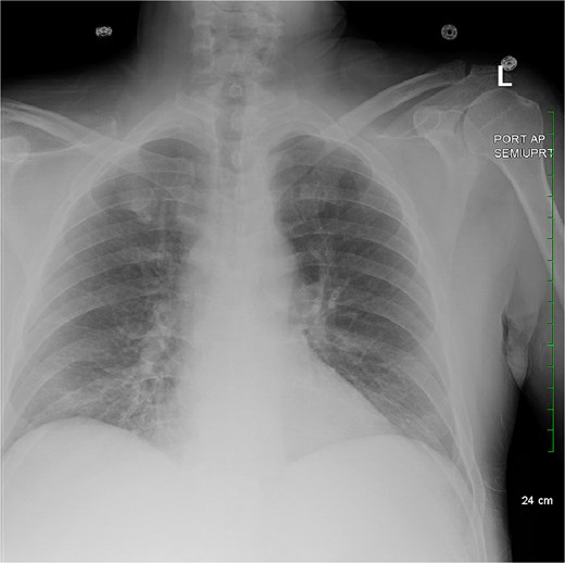 Pre-operative chest X-ray, anterior-posterior.