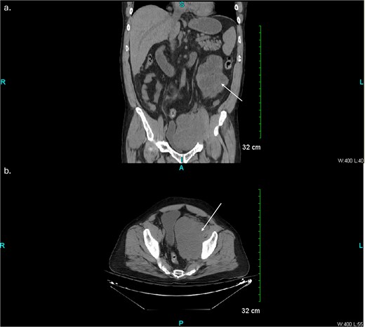 Pre-operative abdominal/pelvic CT scan without contrast, coronal view (top) and axial view (bottom) showing left pelvic sidewall abscess.