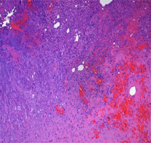 H and E-stained section of the biopsied pelvic abscess cavity.