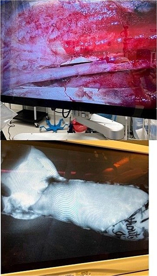 Intraoperative view of the forearm demonstrating a salvaged median nerve protected by an Axoguard Nerve Protector. The nerve is covered by an anterolateral thigh (ALT) free flap before wound closure, with surrounding exposed soft tissues and surgical field visible.