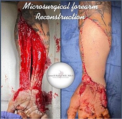 Intraoperative photographs shown side by side of the right volar forearm. The left image shows the wound before reconstruction with exposed underlying tissues. The right image shows the same area after coverage with an anterolateral thigh (ALT) free flap.