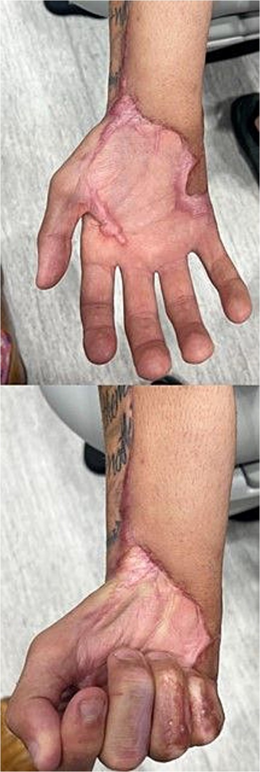 Eight-month postoperative clinical photographs showing a healed reconstructed right volar forearm with a viable anterolateral thigh (ALT) free flap, no visible wound breakdown, and the patient able to achieve a closed hand grip.