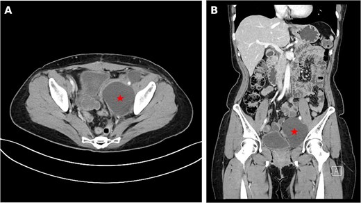 Two-panel CT figure showing a low-attenuation fluid collection in the left pelvic cavity marked by a red star, consistent with an uncomplicated lymphocele, on axial (panel A) and coronal (panel B) views without rim enhancement or adjacent fat stranding.