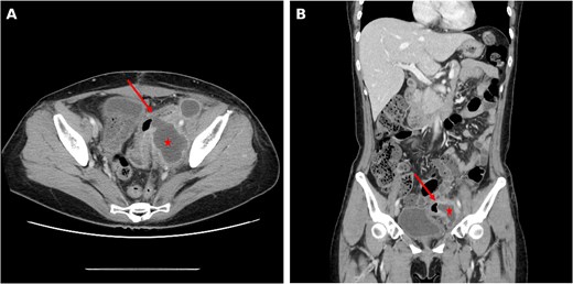 Two-panel CT figure showing interval enlargement of the left pelvic lymphocele marked by a red star, with intralesional gas indicated by a red arrow tracking from the adjacent sigmoid colon, on axial (panel A) and coronal (panel B) views, consistent with infected lymphocele and possible colonic fistula.