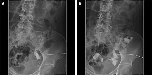 Two-panel fluoroscopic image showing contrast injected through a percutaneous drainage catheter; panel A shows opacification of the lymphocele cavity alone, and panel B shows further contrast filling the sigmoid colon through a 2-cm-wide fistulous communication.