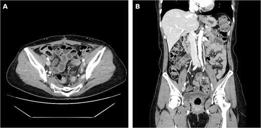 Two-panel postoperative contrast-enhanced CT showing complete resolution of the left pelvic lymphocele and a patent sigmoid colon at the anastomotic site without evidence of leak or fluid collection, on axial (panel A) and coronal (panel B) views.