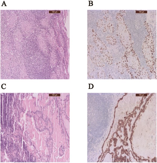 Figure 1 shows representative histopathological and immunohistochemical images of synchronous regional metastases from oral squamous cell carcinoma and papillary thyroid microcarcinoma. Panel A shows H and E staining of metastatic oral squamous cell carcinoma with squamous cell nests and keratinization. Panel B shows p40-positive immunohistochemical staining confirming squamous differentiation. Panel C shows H and E staining of metastatic papillary thyroid microcarcinoma with papillary architecture. Panel D shows CK19-positive immunohistochemical staining supporting thyroid origin.