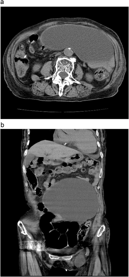 Unenhanced CT images showing a large unilocular cystic abdominal mass without internal septa; axial view (a) and coronal view (b) demonstrating leftward displacement of the cyst.