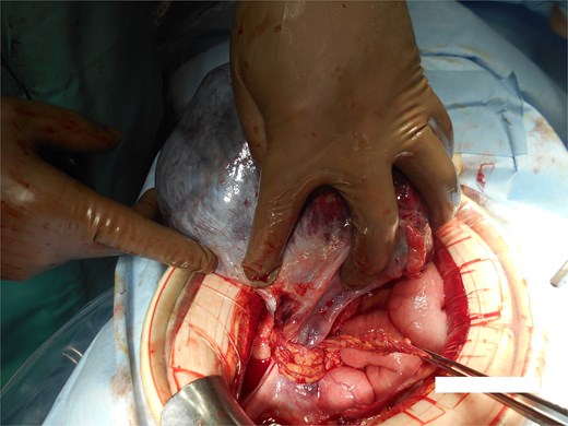 Intraoperative photograph showing the congested right ovarian cyst with the cord-like omental knot at its base and bowel visible in the lower right.