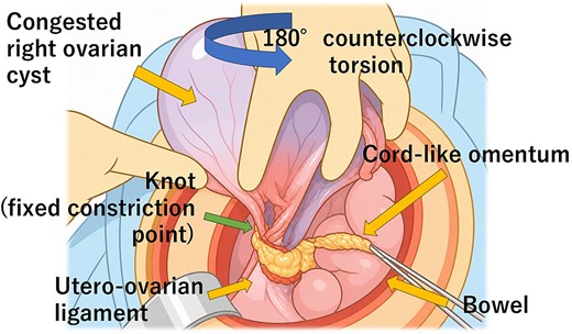 Schematic diagram showing the cord-like omentum looped around the utero-ovarian ligament forming a fixed constriction point, resulting in 180-degree counterclockwise torsion of the right ovary.