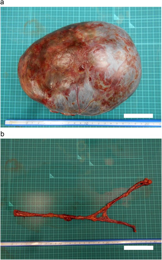 Gross specimen photographs showing (a) the resected right ovarian cyst with hemorrhagic surface changes consistent with torsion-induced ischemia, and (b) the resected cord-like omentum demonstrating its elongated fibrous morphology.