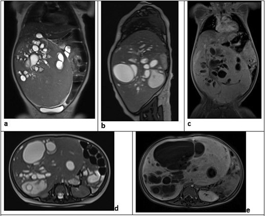 Pre-operative MRI of the abdomen showing five sequences (coronal T2-HASTE, sagittal T2-HASTE, coronal post-contrast T1, axial T2-HASTE, and axial post-contrast T1) of a large heterogeneous exophytic mass arising from the inferior right hepatic lobe in an 8-month-old female infant. The mass has multilocular internal cystic components with no cystic enhancement, moderate homogeneous enhancement of the solid component, and right hepatic vessels crossing into the lesion.