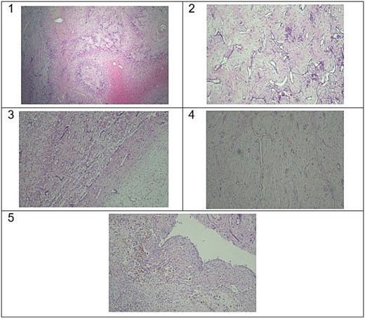 Five histopathological photomicrographs of hepatic mesenchymal hamartoma. Panel 1 (haematoxylin and eosin, x4): loss of normal hepatic lobular architecture with absence of portal tracts. Panel 2 (haematoxylin and eosin, x10): bland spindle cell myxoid stroma with collagen containing branching and dilated bile ducts without cytological atypia. Panel 3 (haematoxylin and eosin, x10): entrapped hepatocytes with retention of normal cell plate architecture. Panel 4 (haematoxylin and eosin, x10): mesenchymal areas of bland spindle cells in loose stroma. Panel 5 (haematoxylin and eosin, x10): areas of cystic degeneration with haemosiderin deposition.