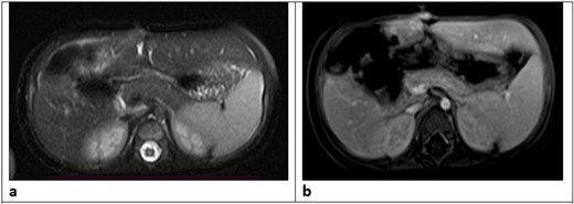 Post-operative MRI follow-up of the abdomen in an 8-month-old female infant four months after open right hepatectomy for giant hepatic mesenchymal hamartoma. Two sequences are shown: axial T2 HASTE-FS (a) and post-contrast T1 VIBE-DIXON (b), both demonstrating a clear operative bed with no residual enhancing lesions, no postoperative collections, and no evidence of residual or recurrent hepatic disease.