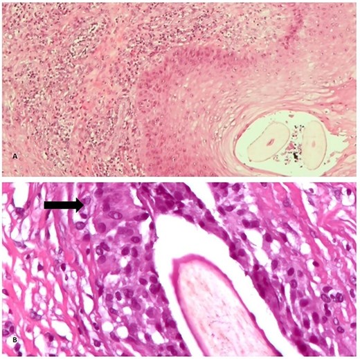 Histopathological examination of the specimen (Hematoxylin and Eosin stain). (a) Pilonidal sinus with areas of chronic inflammation and degenerative hair shaft (40×). (b) At high magnification hair shafts are seen in the center of this pilonidal sinus, surrounded by inflammation with foreign body giant cells (arrow) (400×).