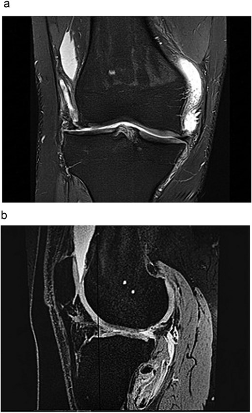 (a) A coronal plane magnetic resonance imaging scan of a right knee showing loss of meniscal tissue in both the medial and lateral compartments, fluid accumulation in the joint, and structural changes from a previous anterior cruciate ligament surgery. (b) A sagittal plane magnetic resonance imaging scan of a right knee displaying significant loss of meniscal tissue, joint fluid, and surgical changes from a past anterior cruciate ligament reconstruction.