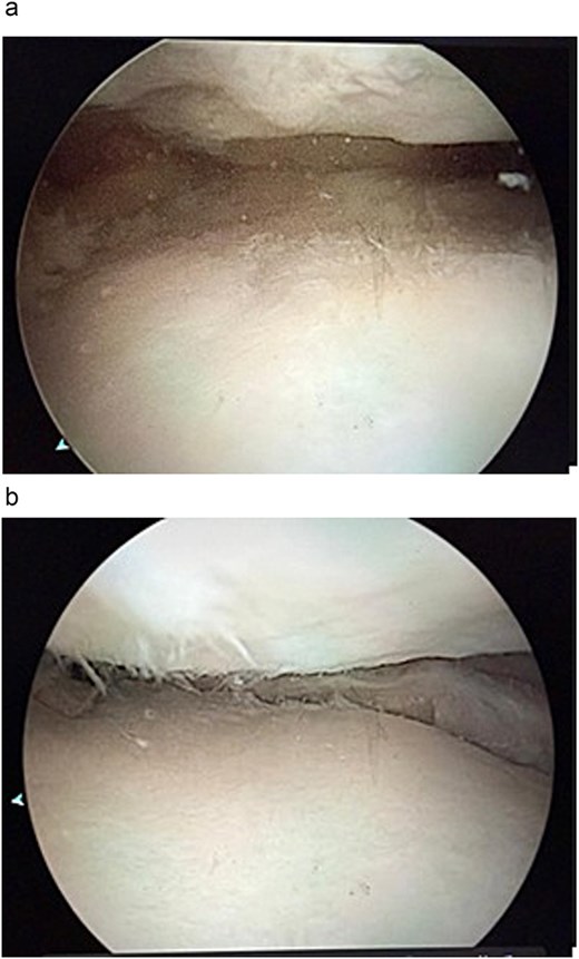 (a) An arthroscopic view of the lateral compartment of a right knee revealing an almost complete lack of native meniscal tissue and exposed bone on the lateral tibial plateau. (b) An arthroscopic view of the medial compartment of a right knee showing severe lack of meniscal tissue and exposed tibial cartilage resulting from a previous meniscectomy.