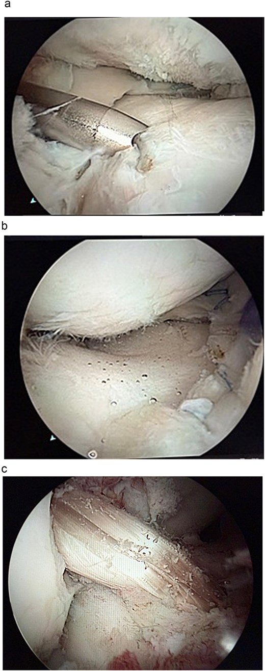 (a) An arthroscopic view of the lateral compartment of a right knee after meniscal allograft transplantation, showing a newly implanted lateral meniscus covering the previously exposed tibial plateau. (b) An arthroscopic view of the medial compartment of a right knee after meniscal allograft transplantation, displaying the newly implanted medial meniscus correctly positioned within the joint. (c) An arthroscopic view of the intercondylar notch of a right knee showing a newly reconstructed anterior cruciate ligament using an allograft, appearing well-positioned and properly tensioned.