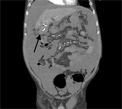 Pericholecystic hematoma without delineation of the inferior margins of the gallbladder.