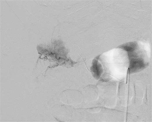 Small cystic artery pseudoaneurysm with complex perfusion.