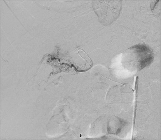 Post-embolization of cystic artery pseudoaneurysm.