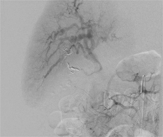 Post-embolization of cystic artery pseudoaneurysm.