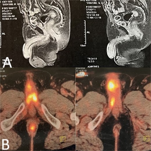Panel A shows a pelvic MRI image with a heterogeneously enhancing mass visible in the bilateral corpora cavernosa of the penis at the level of the penile base. Panel B displays an axial FDG-PET/CT image demonstrating intensely avid metabolic activity in the penile root and shaft, consistent with metastatic disease.
