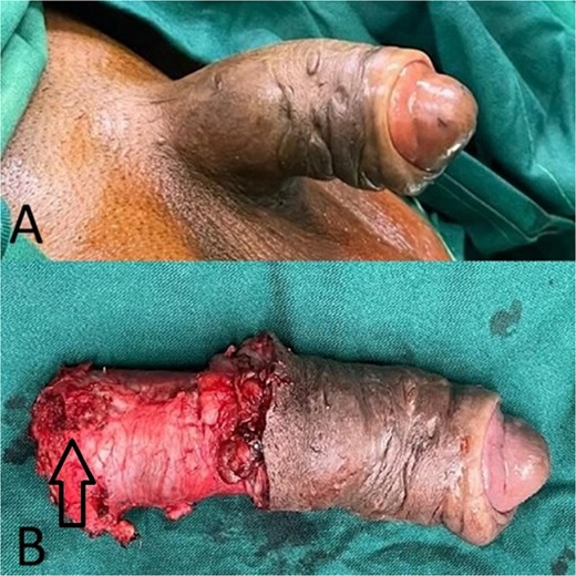 Two-panel clinical and surgical image. Panel A: preoperative photograph showing a sustained swollen penile erection with dusty glans. Panel B: gross specimen following total penectomy showing tumor infiltration replacing the proximal corpora cavernosa.