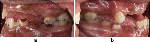 Two intraoral photographs of a child's mouth: side (a) shows the right side with several missing teeth and decayed primary molars; side (b) shows the left side with several missing permanent teeth and a visibly smaller upper jaw compared to the lower jaw.