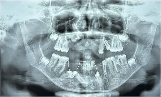 Panoramic dental X-ray taken two weeks after surgery, showing three lower teeth with small metal buttons and wires attached for orthodontic pulling, while two upper teeth remain unerupted and embedded in the bone.